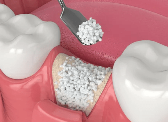 Dental bone grafting in Queens, NY.